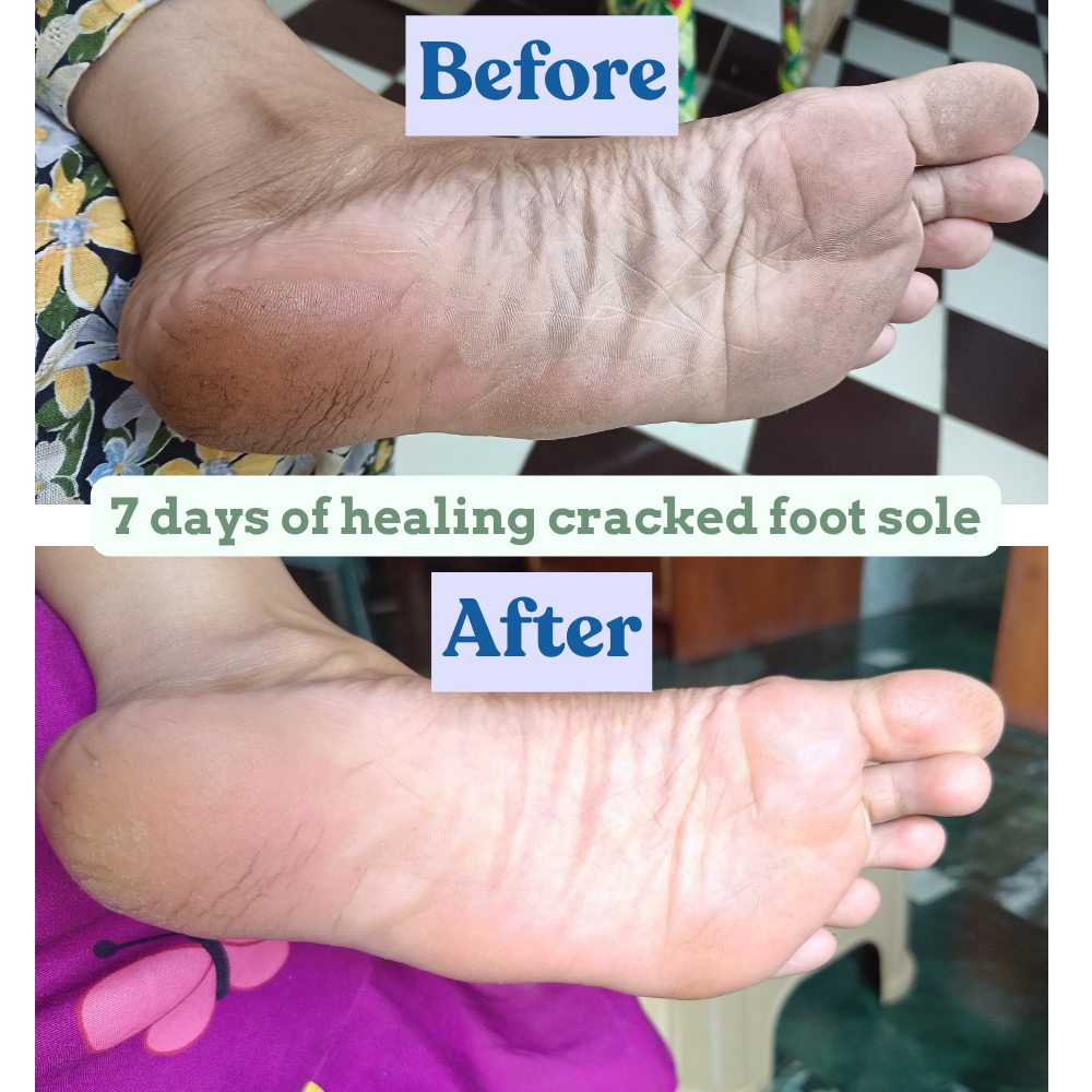 Healing heel balm